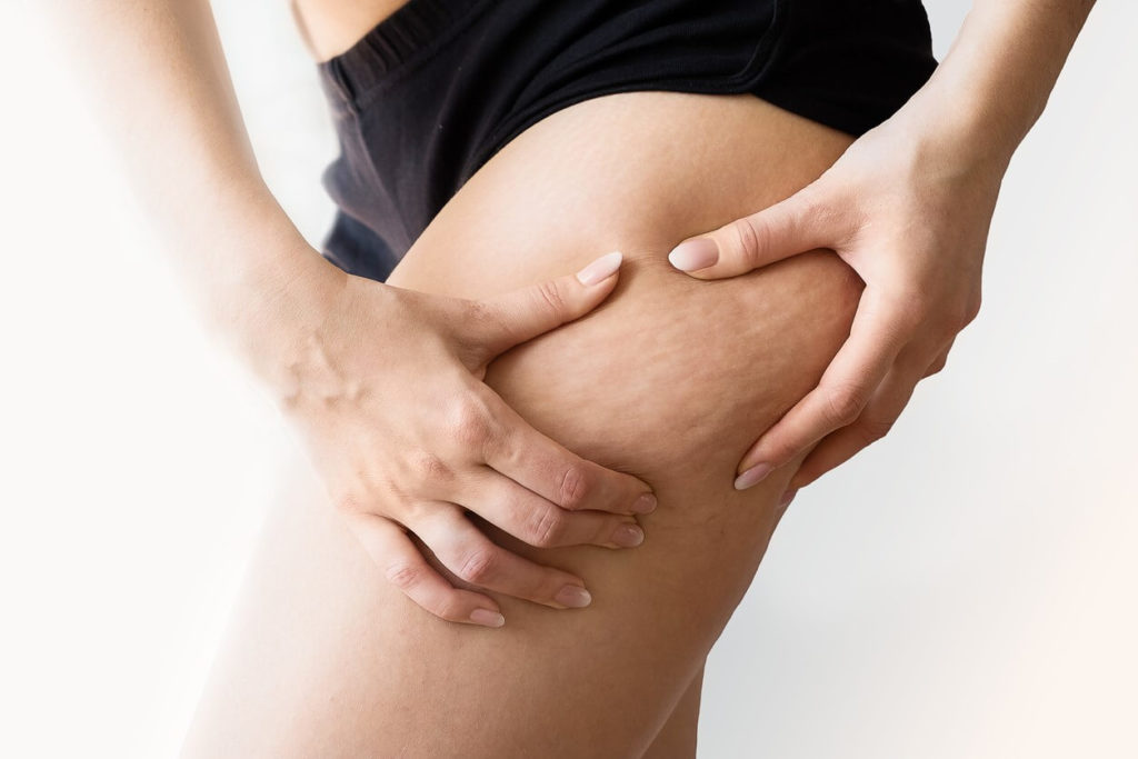 Comment faire pour enlever la cellulite ?