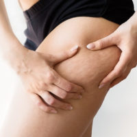 Comment faire pour enlever la cellulite ?