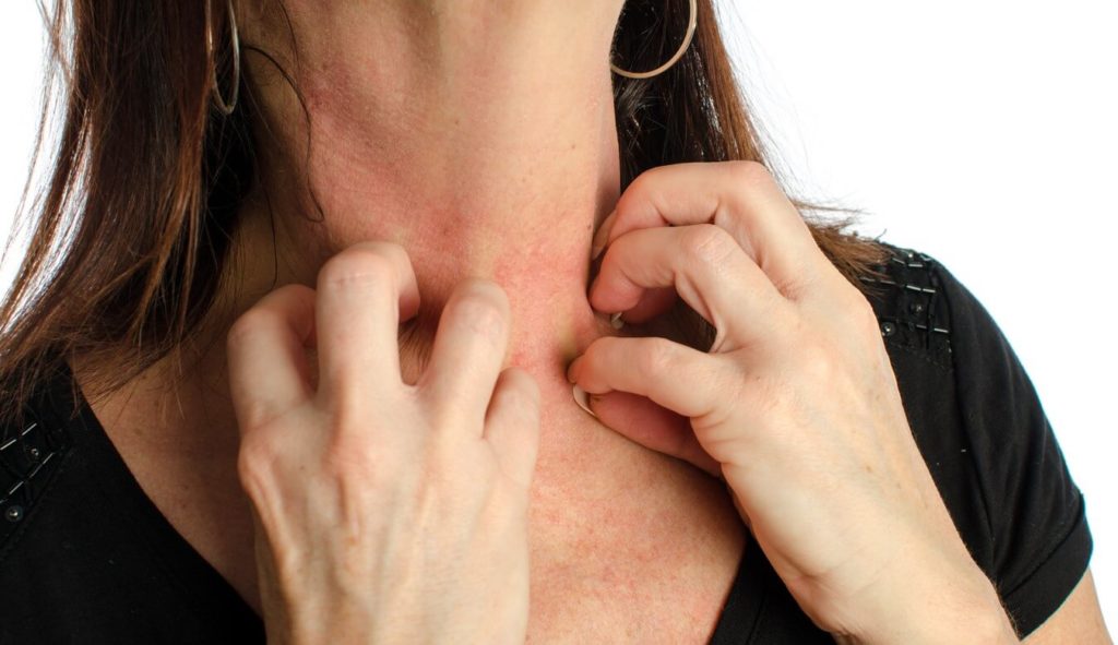 Eczema : comment s'en débarasser naturellement ?