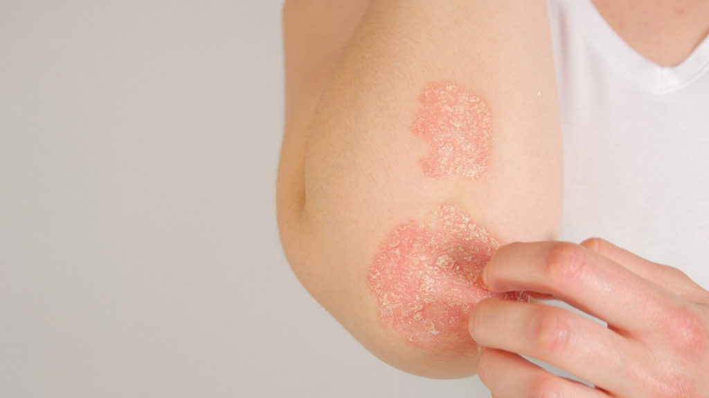 Psoriasis : comment soigner naturellement ?