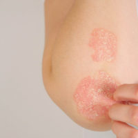 Psoriasis : comment soigner naturellement ?